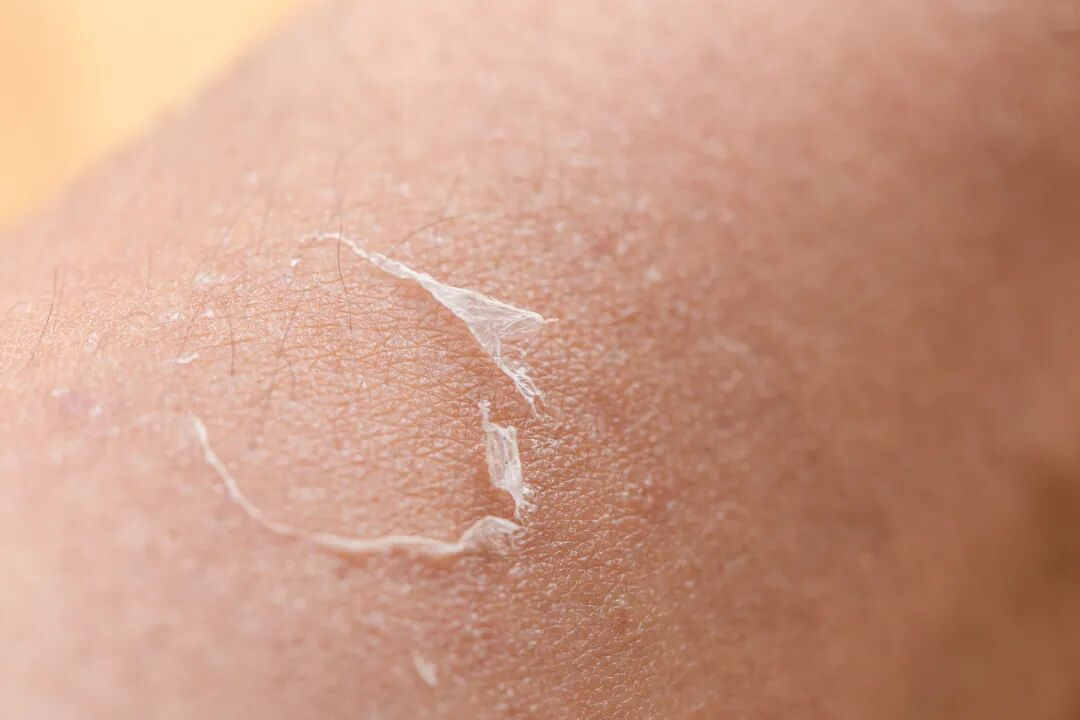 生姜、牙膏能祛斑？不仅无用，反而可能有害 